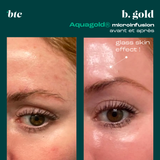 Aquagold® microinfusion