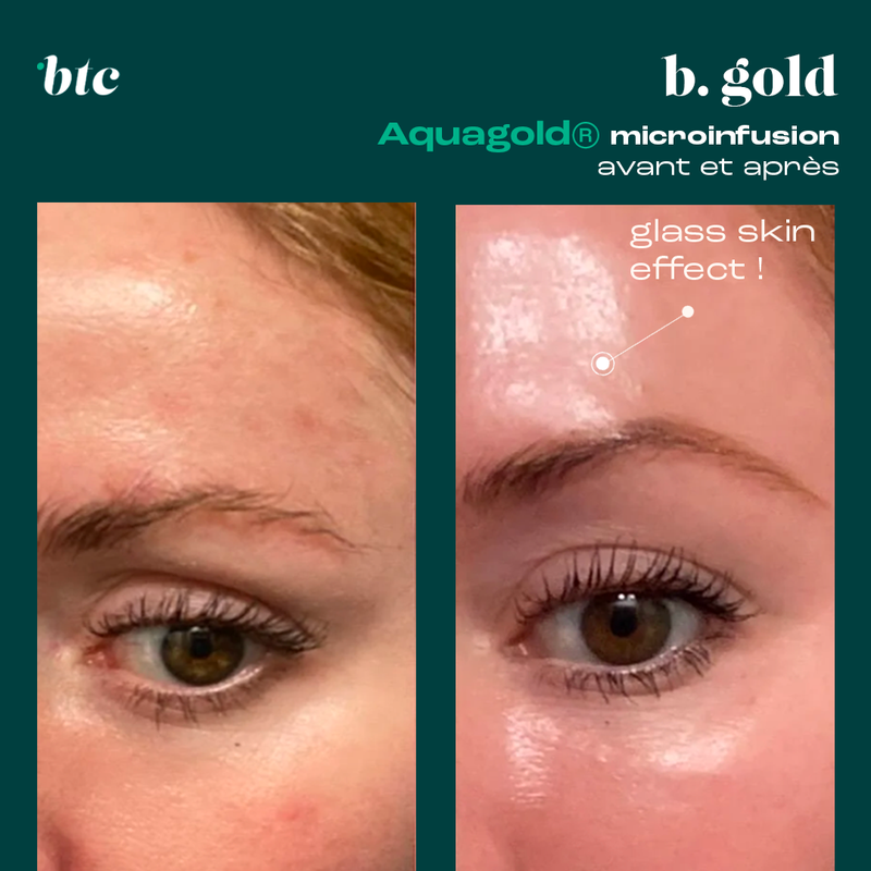 Aquagold® microinfusion