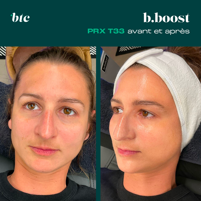 Skinbooster biorevitalisant PRXT33® (sans injections)