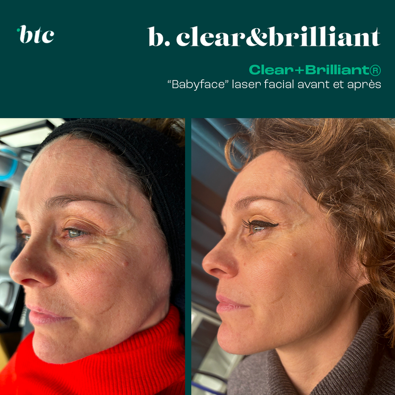 Babyface laser facial Clear+Brilliant®⚡️