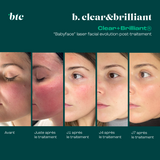 Babyface laser facial Clear+Brilliant®⚡️
