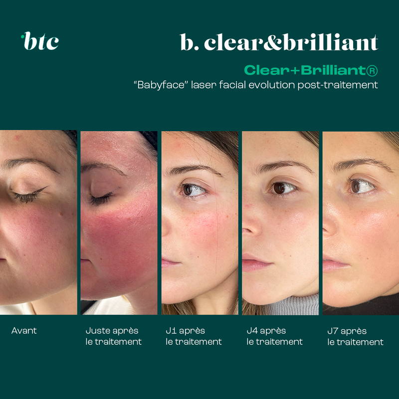 Babyface laser facial Clear+Brilliant®⚡️