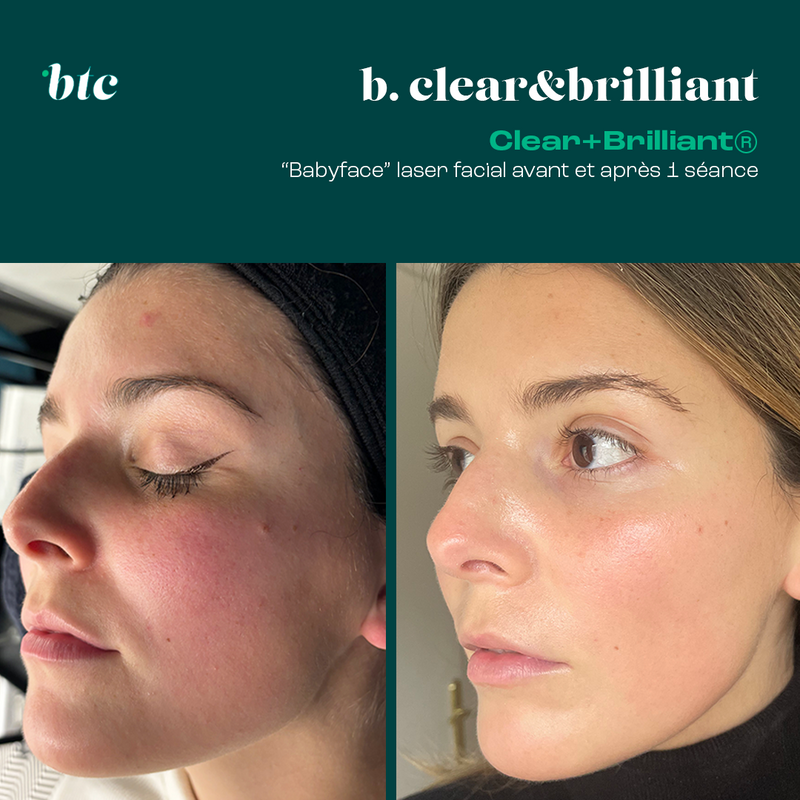 Babyface laser facial Clear+Brilliant®⚡️