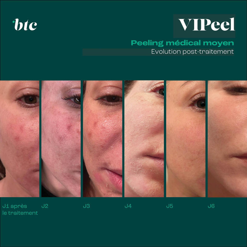 Peeling médical 🧪