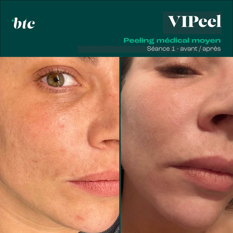 Peeling médical 🧪
