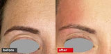 Laser Fotona® (COMING SOON)