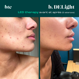 Photobiomodulation/LED therapy✨