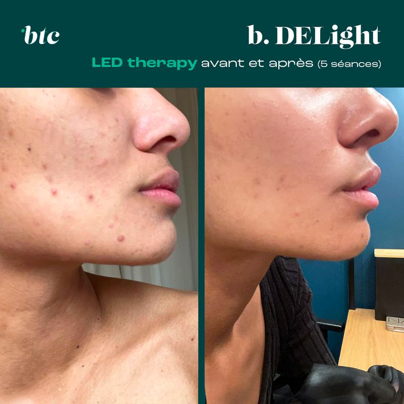 Photobiomodulation/LED therapy✨