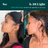 Photobiomodulation/LED therapy✨
