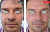 Laser Fotona® (COMING SOON)