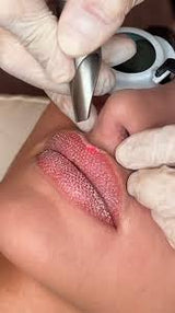 Laser Fotona® LipLase™⚡️💋 (repulpage lèvres sans injection)