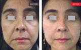 Laser Fotona® (COMING SOON)